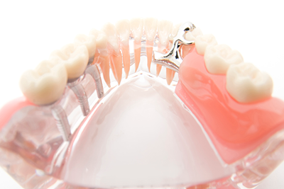 入れ歯（義歯）