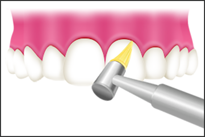 ③歯と歯の隙間を清掃