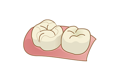 セラミックインレー