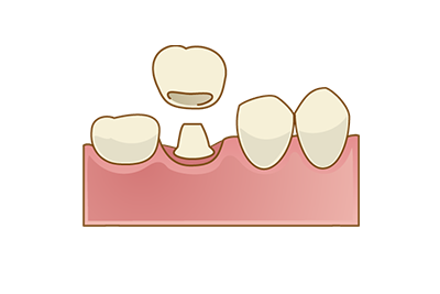 セラミッククラウン・セラミックブリッジ
