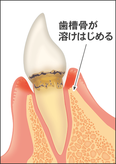前歯の軽度な歯周病