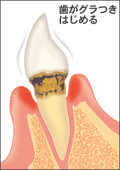 前歯の中度な歯周病