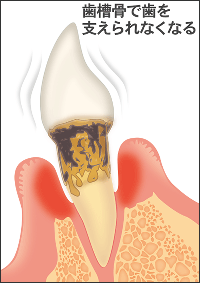 前歯の重度な歯周病