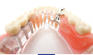 入れ歯（義歯）